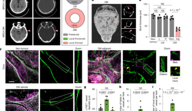 Osteoclasts intercept meningeal lymphatic paths for dural metastasis