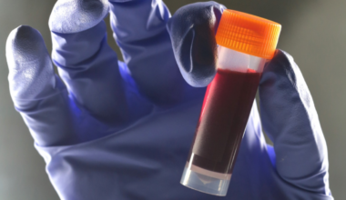 One Blood Type Seems to Carry a Higher Risk of Type 2 Diabetes : ScienceAlert