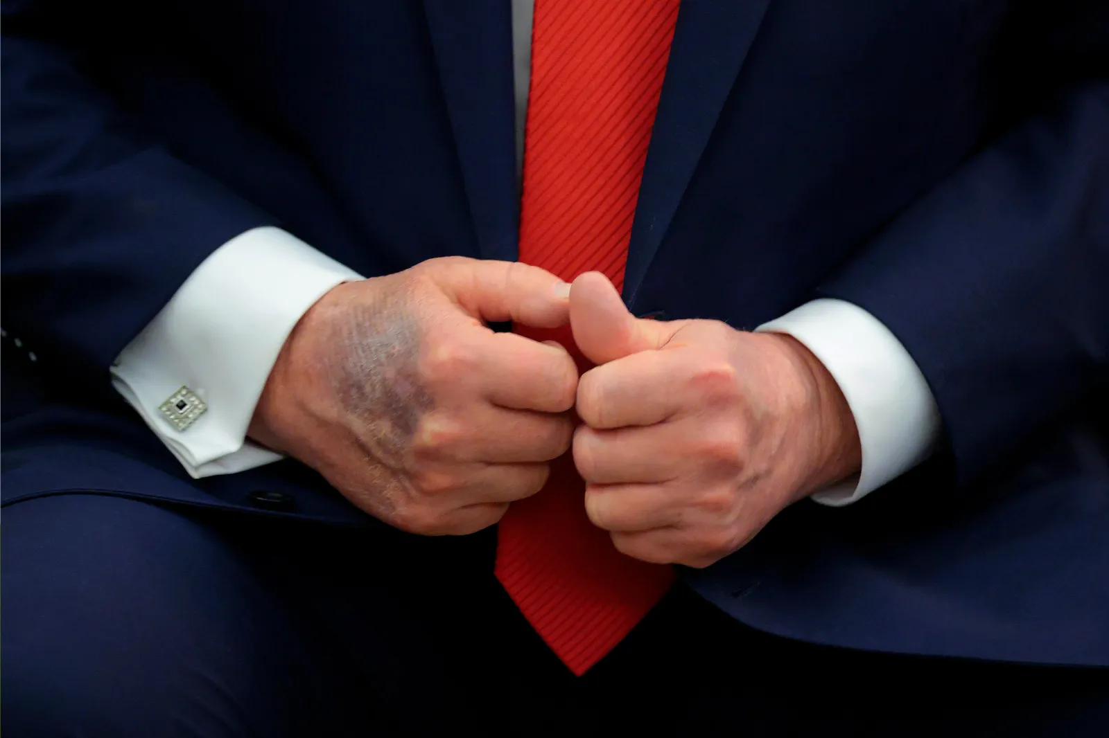 A bruise is visible on the back of U.S. President Donald Trump's right hand during a meeting with South Korean President Lee Jae-myung in the Oval Office at the White House on August 25, 2025 in Washington, DC.