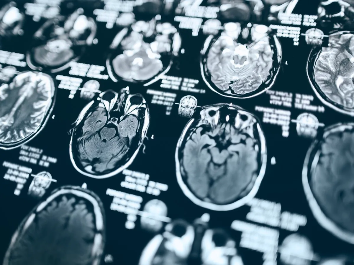 Magnetic resonance imaging of the brain.