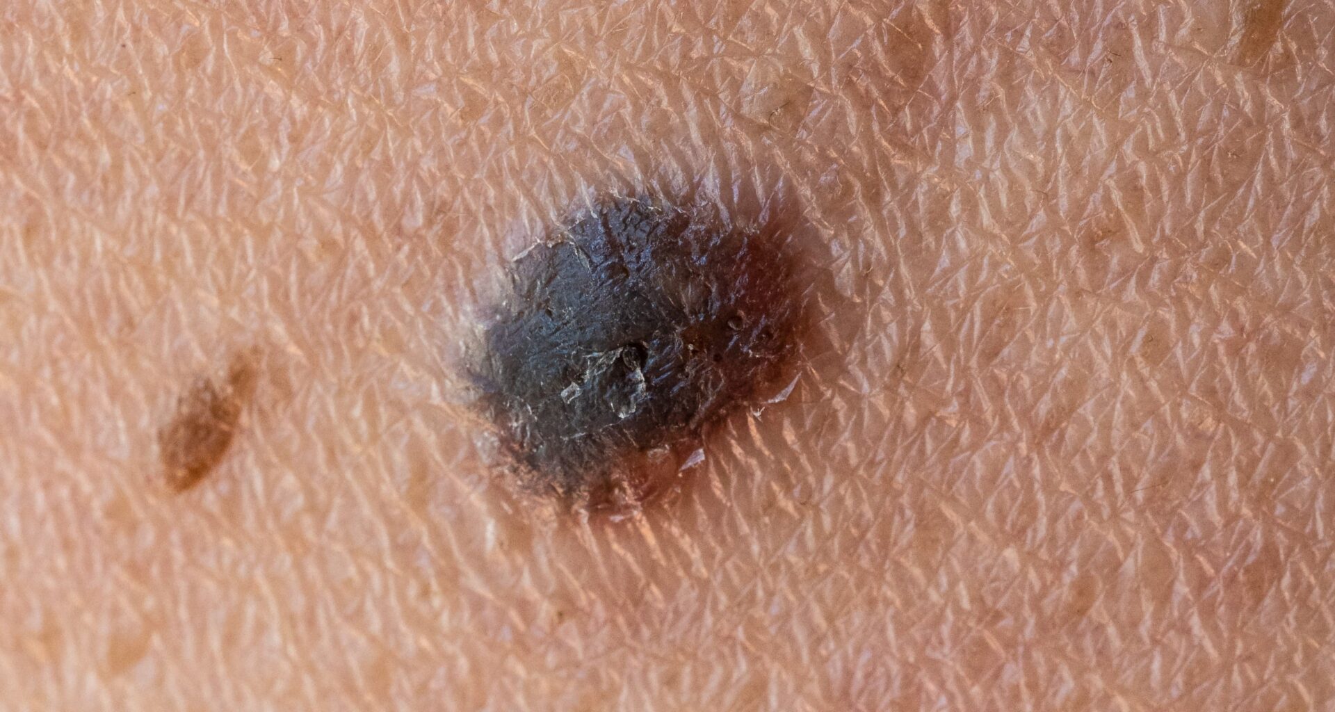 World-First Cancer Vaccine Cuts Melanoma Recurrence or Death Risk by 42% in Landmark Trial : ScienceAlert