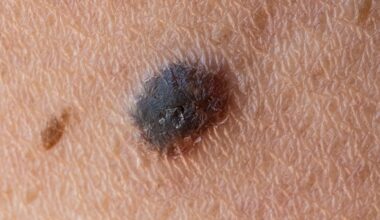 World-First Cancer Vaccine Cuts Melanoma Recurrence or Death Risk by 42% in Landmark Trial : ScienceAlert