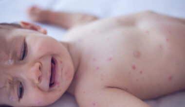 Crying baby girl with measles