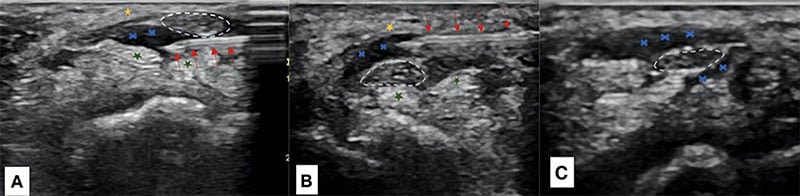 Three ultrasound images showing needle placement and fluid spreading around the wrist nerve.