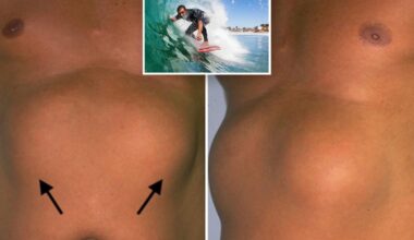 Strange benign chest lumps found in SoCal surfers