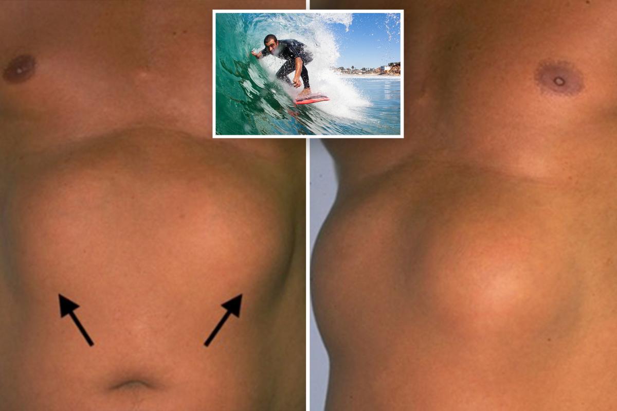 Strange benign chest lumps found in SoCal surfers
