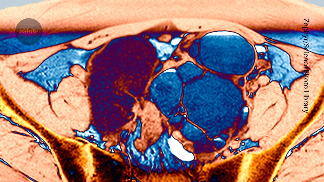 The ‘missed disease’ that affects 190 million: endometriosis drug shows early promise