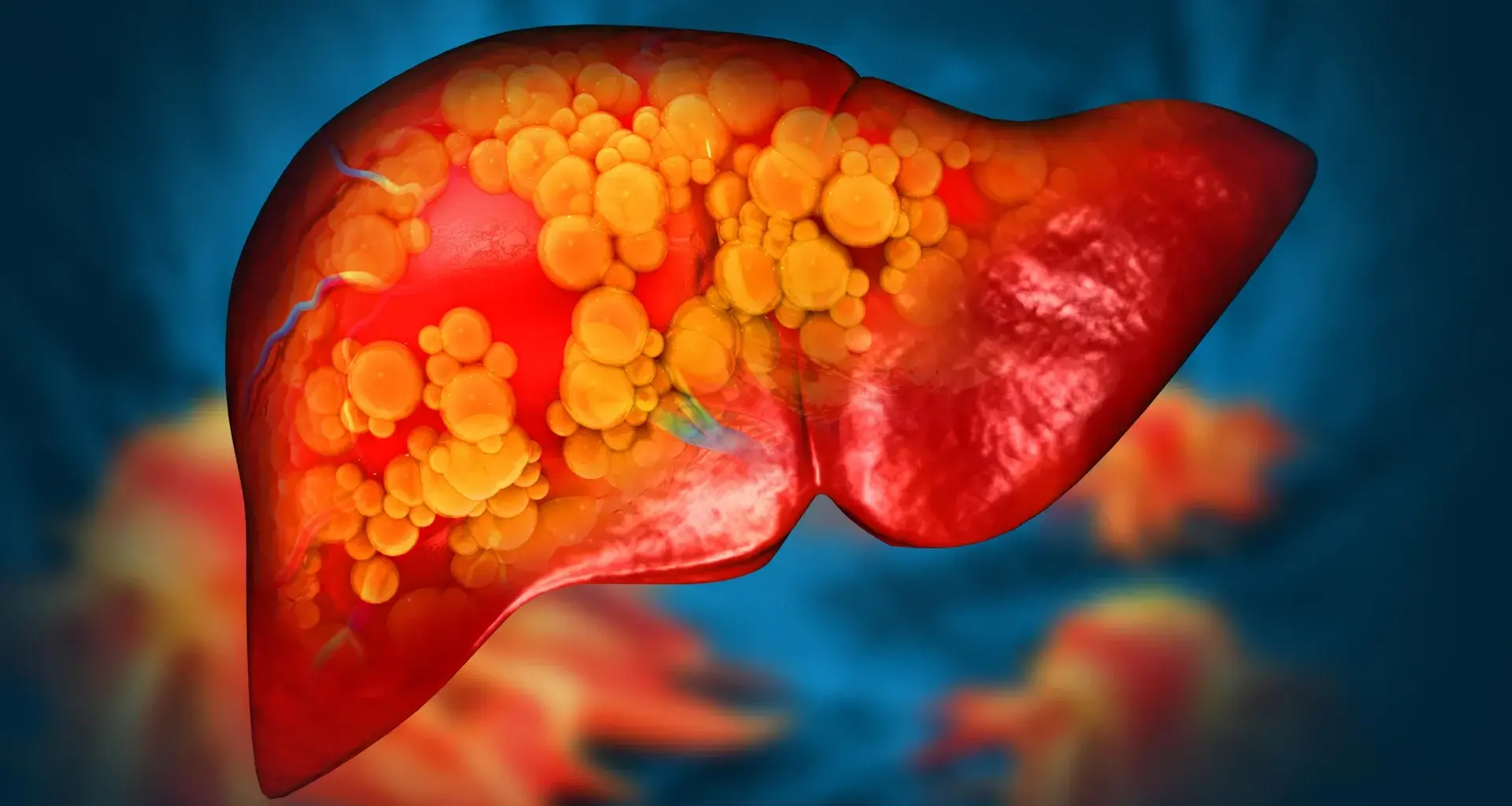 New drug reverses severe fatty liver disease by repairing the gut