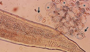 Worms mate in man's eyes, get plucked out right before larvae burst out