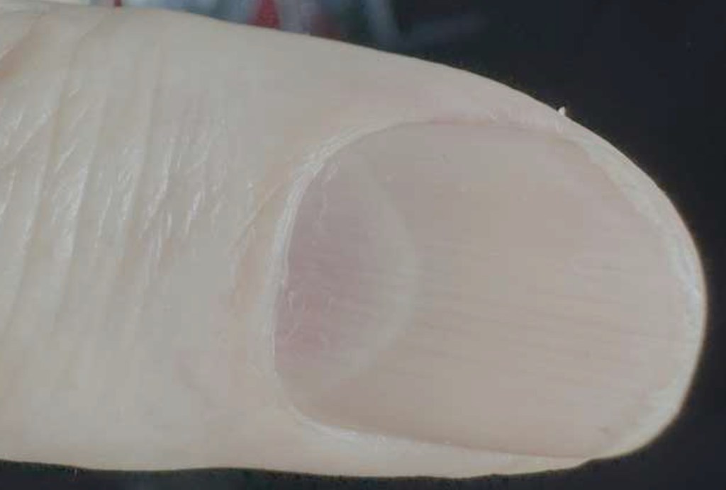 A close-up photograph of a fingernail showing a symptom associated with serious health conditions.