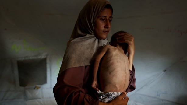 A woman holds her child who is showing signs of malnutrition in Gaza