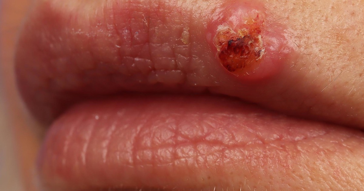 A type of HPV has been found to cause skin cancer, according to a new report