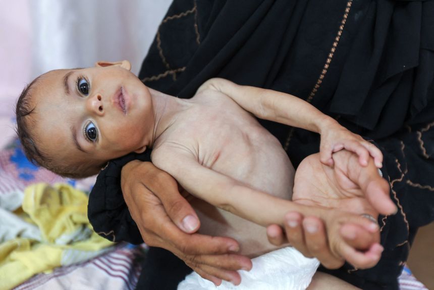 Seela Barbakh, an 11-month-old Palestinian girl who is malnourished according to medics, is held by her mother Najah at Nasser Hospital in Khan Younis, Gaza on Wednesday.