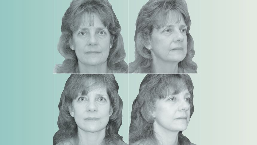 Kimberly Bongiorno pictured before (top) and after (bottom) her face and neck lift.