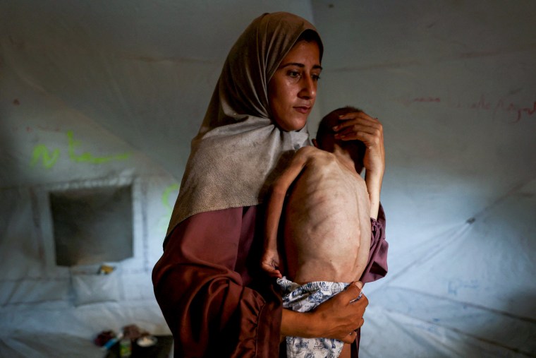 A woman holds her baby suffering malnutrition.