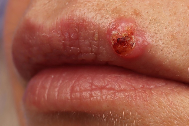 Squamous cell carcinoma