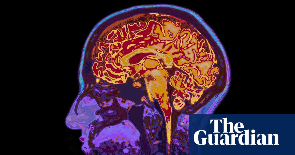 ‘Slip, slop, slap for brain health’: Australia needs a major prevention campaign for dementia, doctor says | Health