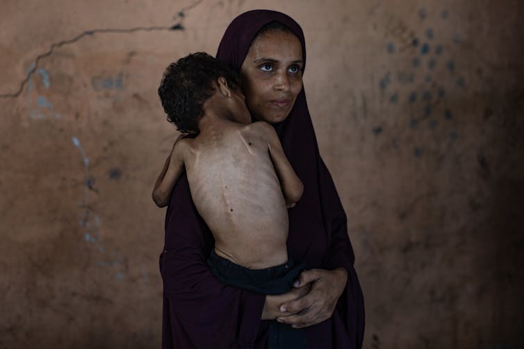 An emaciated child held by his mother.