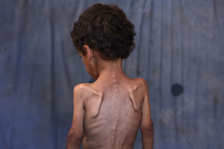 Yazan, a malnourished 2-year-old Palestinian boy, stands with his back turned in his family's damaged home in the Al-Shati refugee camp, west of Gaza City, on July 23.
