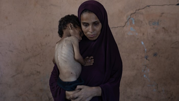 A two-year-old boy suffering from severe malnutrition is held by his mother at a refugee camp near Gaza City