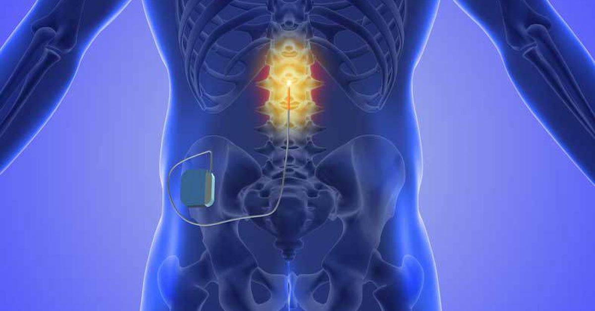Doctors call for use of spinal cord stimulators to be reconsidered
