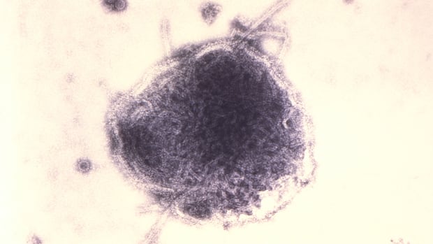 Number of measles cases in N.S. continues to rise