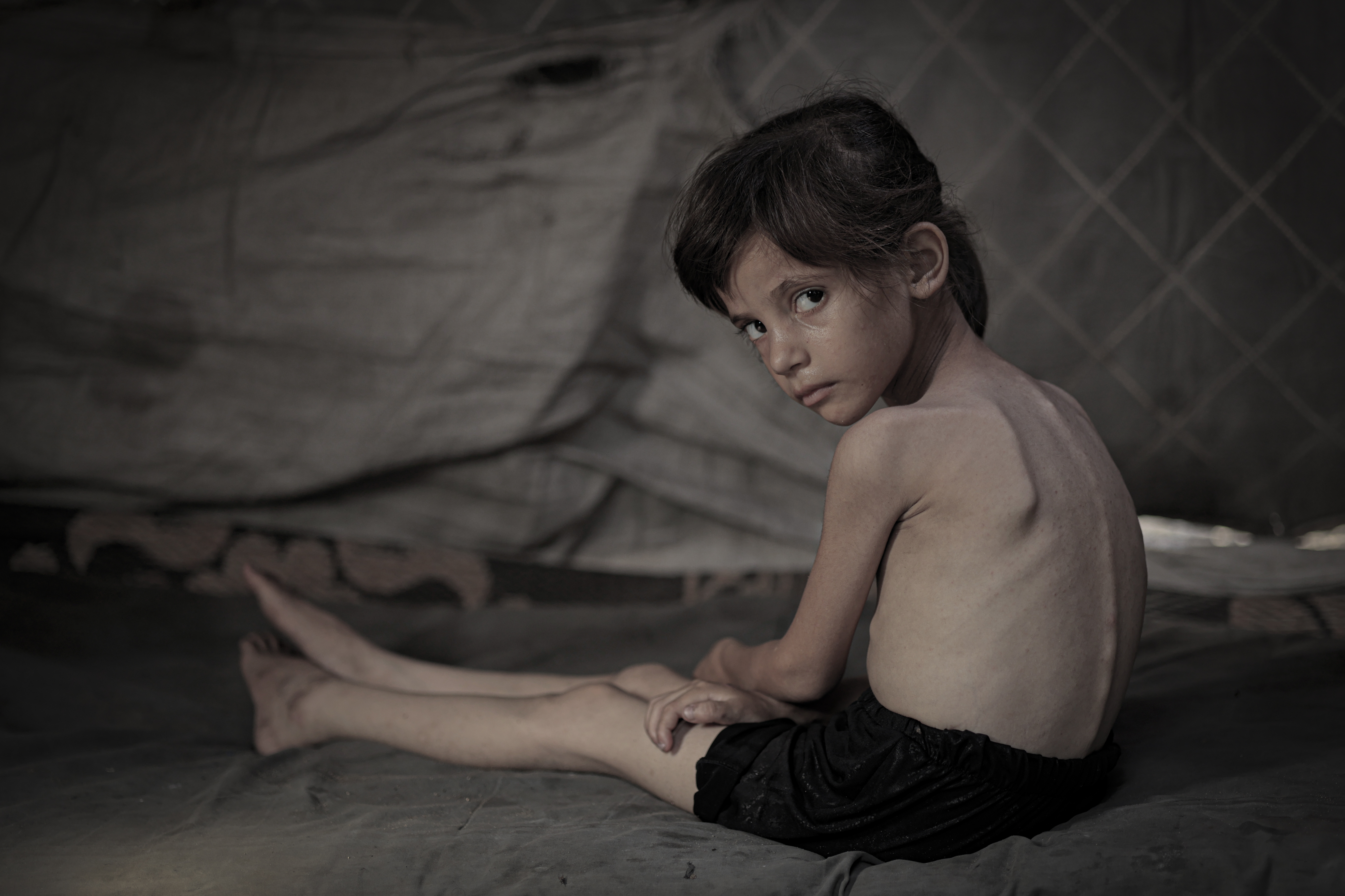 Salih Juha, pictured on July 28 aged five, is severely malnourished