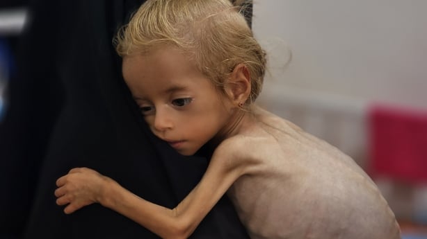 A two year old child showing signs of severe malnutrition is held by her mother 