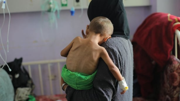 A child showing signs of malnutrition is held by a woman in a hospital setting 