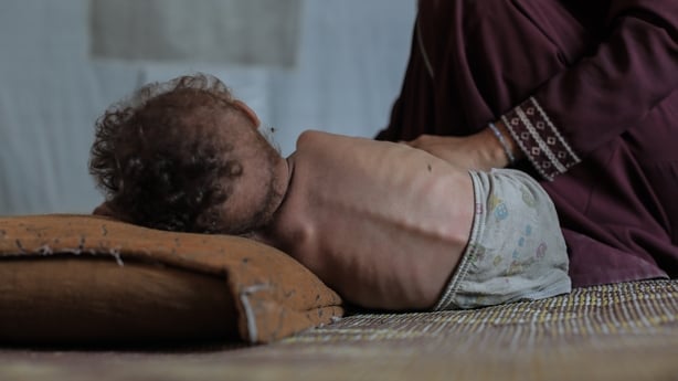 A three year old child lying on the floor of a tent with clear signs of malnutrition