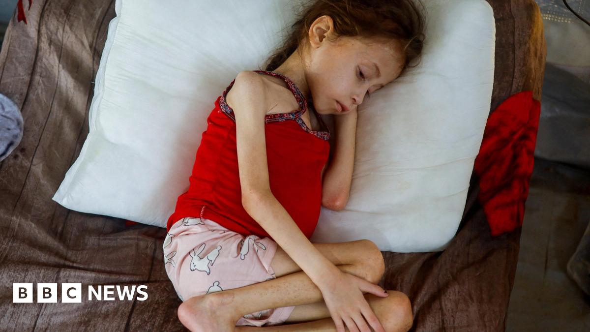 A Palestinian girl Jana Ayad, who is malnourished, according to medics, rests on a bed as she receives treatment at the International Medical Corps field hospital.