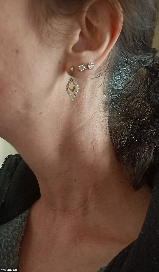 Post-surgery, she was left with a 13cm scar running from her ear down her neck