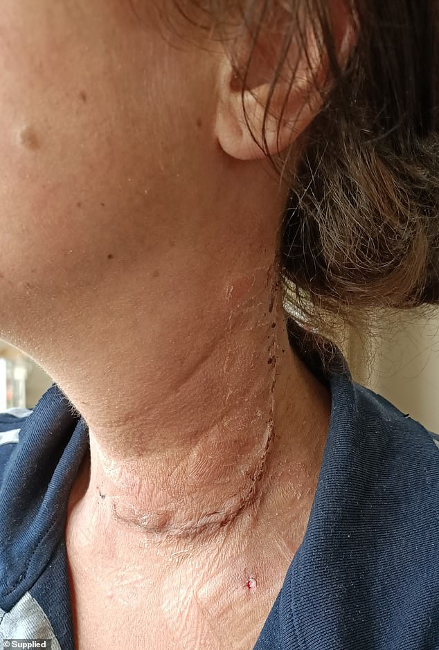 A biopsy confirmed the worst. She had thyroid cancer which had spread to her lymph nodes and she needed surgery immediately. Pictured: Deborah Post-surgery