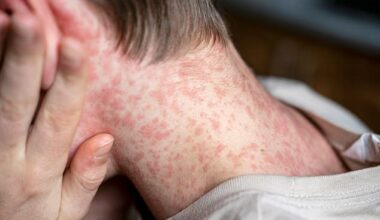 The man had returned from Bali, where he is believed to have caught the illness  (stock)