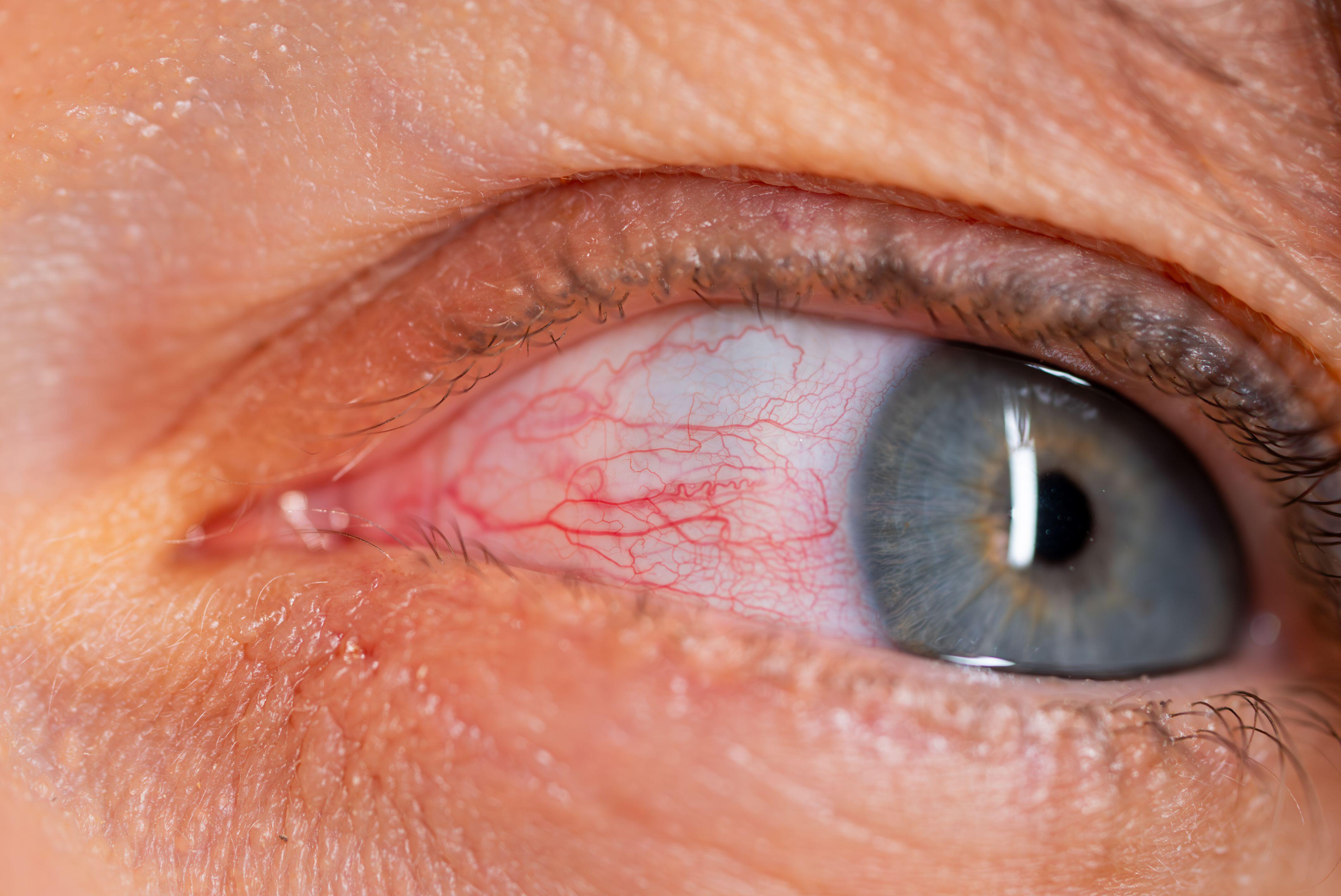 Bimatoprost can cause burning, redness, dryness and eye irritation