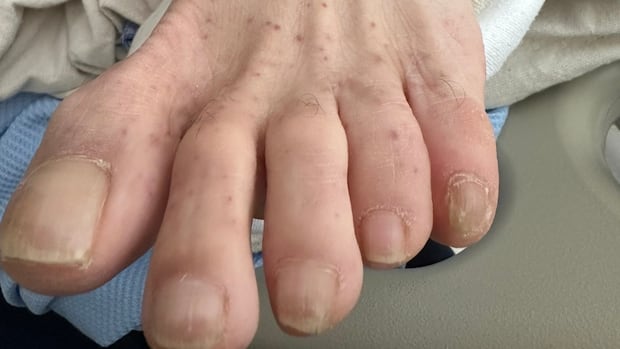 Tick-borne Rocky Mountain spotted fever spreading in Canada