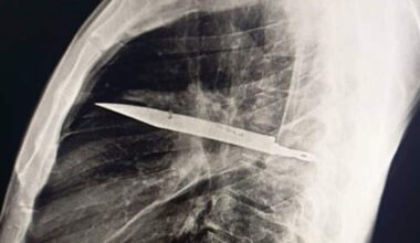 Scan shows knife stuck deep inside a 44-year-old man's chest from an attack 8 years earlier: ‘He denied any chest pain’ | Health