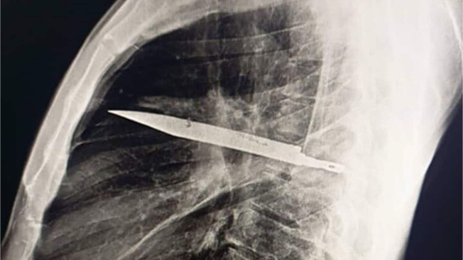 Scan shows knife stuck deep inside a 44-year-old man's chest from an attack 8 years earlier: ‘He denied any chest pain’ | Health