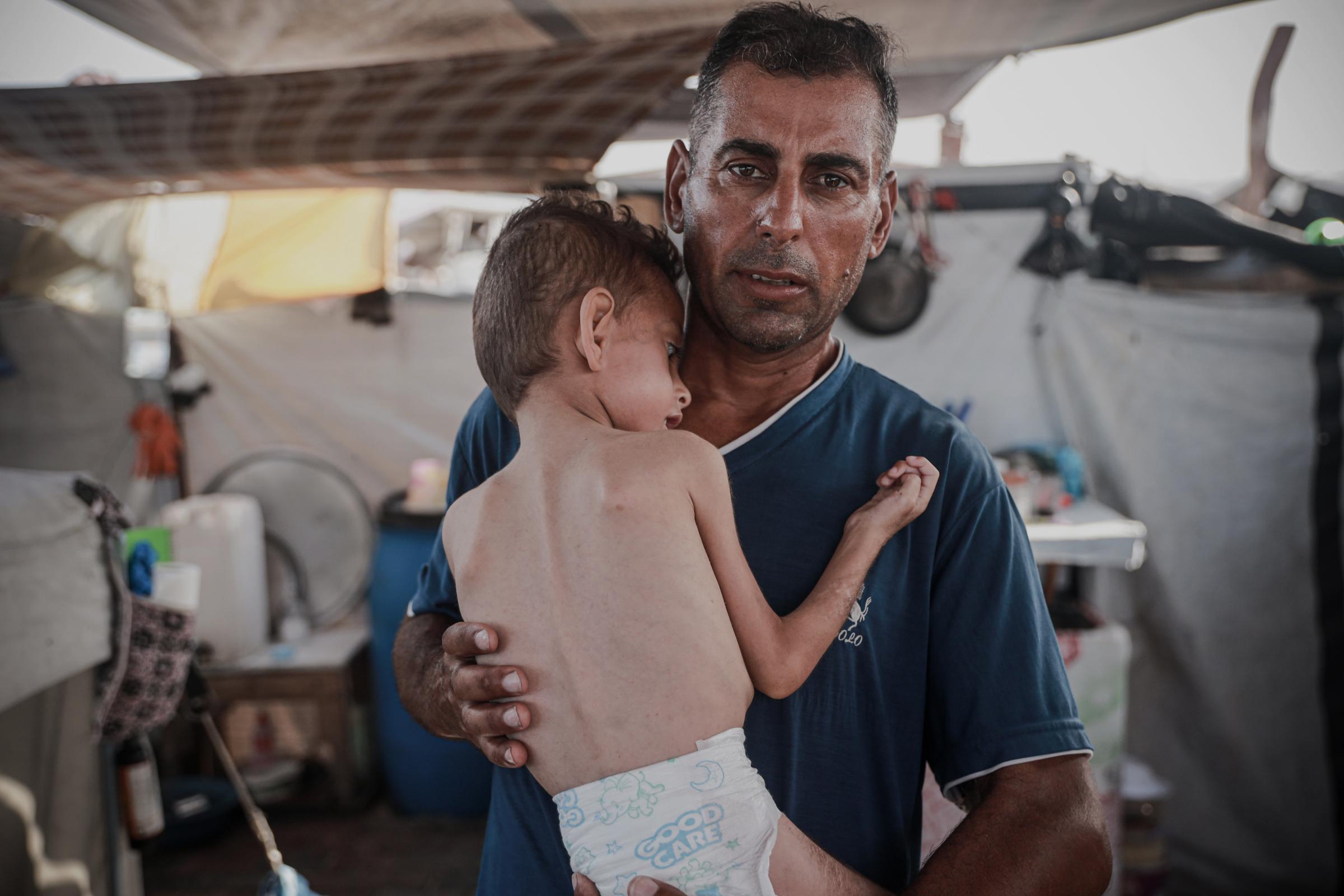 5-year-old polio patient faces life-threatening malnutrition in Gaza refugee camp. GAZA CITY, GAZA - AUGUST 20: A view of 5-year-old polio patient Yamen Zayed, who was displaced with his family due to Israeli attacks and the blockade on Gaza, as he