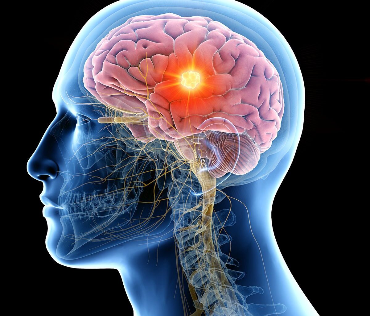 Vorasidenib for the Treatment of Astrocytoma/Oligodendroglioma