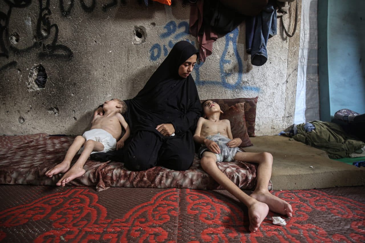 The two brothers, Youssef Abdel Rahman Matar, 6, and Amir Abdel Rahman Matar, 4, are cared for by their mother inside a school sheltering displaced families in Gaza City as they face life-threatening severe malnutrition. (Photo: Omar Ashtawy/ APA Images)
