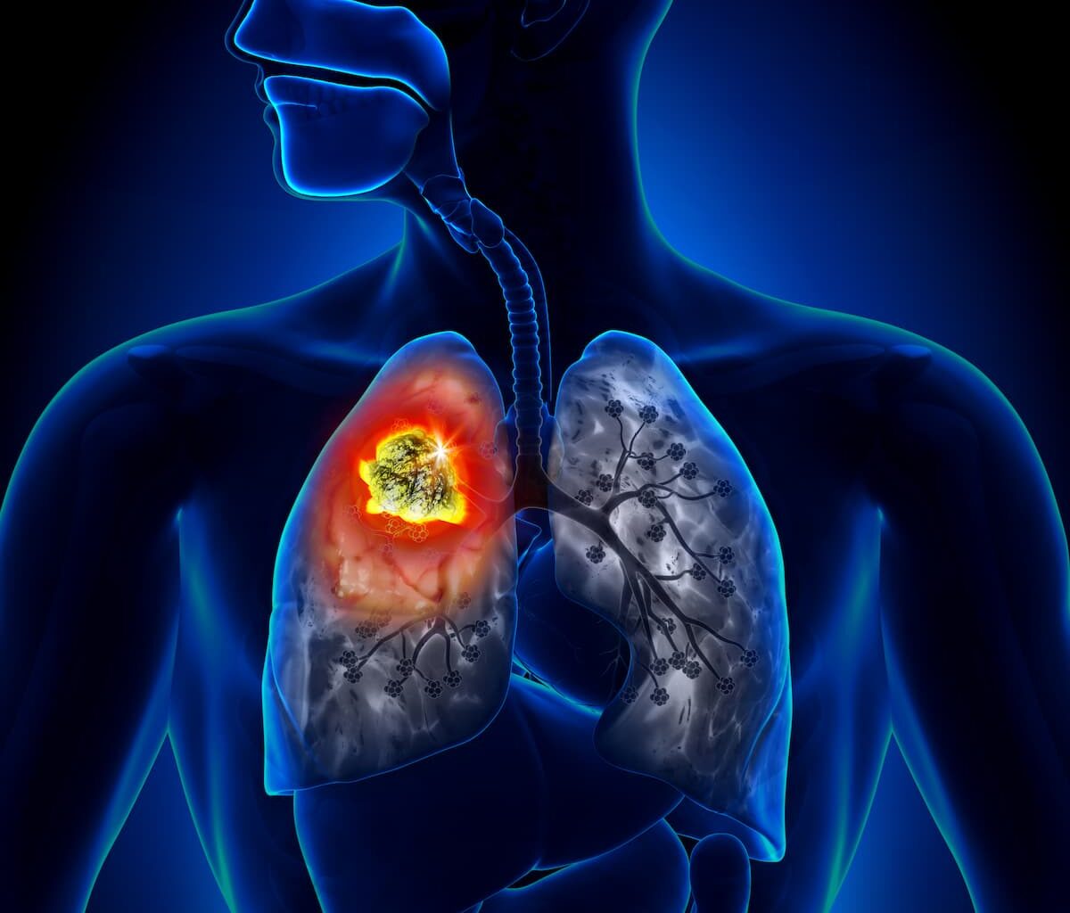 NCCN Guidelines Add LEMS Antibody Testing for SCLC