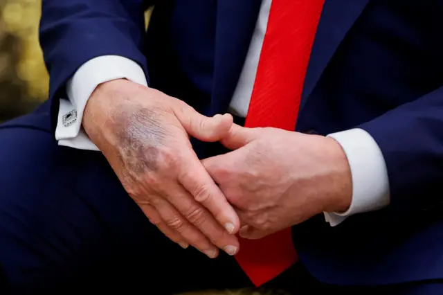 A bruise on Trump's right hand