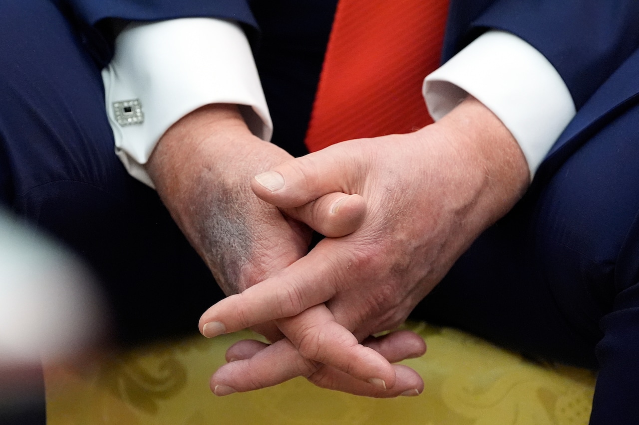 What is that bruise on Trump’s hand? Here’s the White House’s explanation