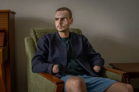 Nazar Bokhii sits in a green chair wearing a dark blue jacket and light blue shorts, his face scarred by an explosion