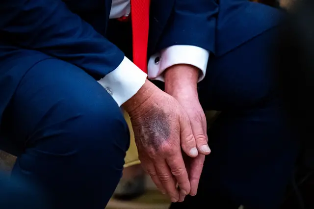A bruise on Trump's right hand