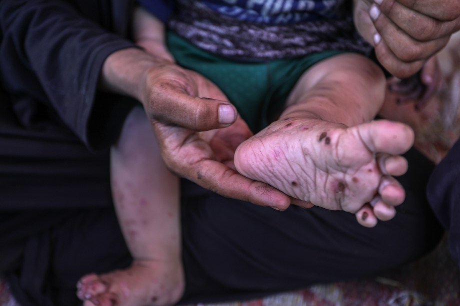 Gaza baby’s skin rots as war and hunger tighten their grip – Middle East Monitor