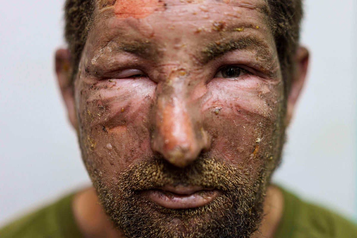 High-tech drones turn Ukraine’s front line into a kill zone. Medics can’t keep up