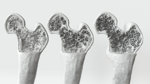 3D rendering of the three stages of osteoporosis featuring progressive bone loss.