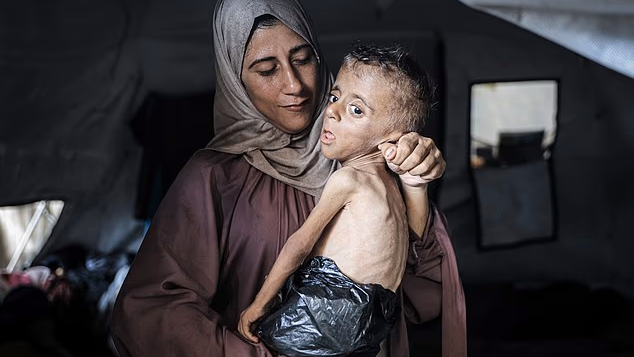 Complex medical conditions of Gaza toddler portrayed as starving in viral photo revea
